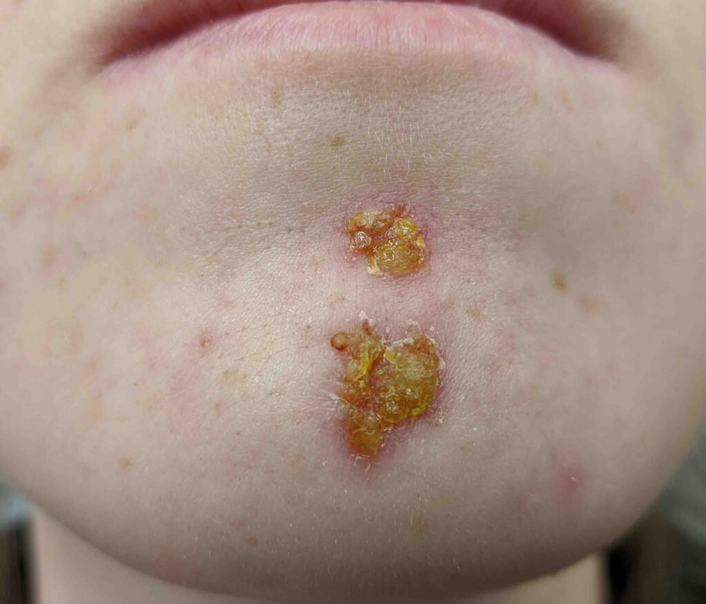 impetigo - red rashses and blisters - infected skin - free nhs consultations